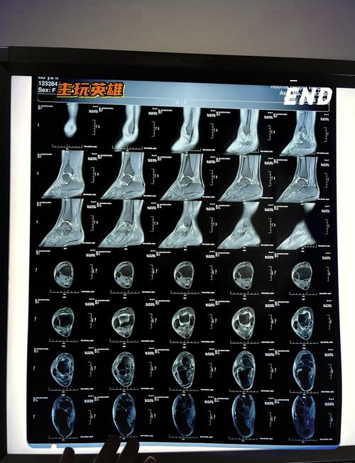 科尔：巴特勒昨天做了脚踝核磁共振检查 结果很正常我们并不担心